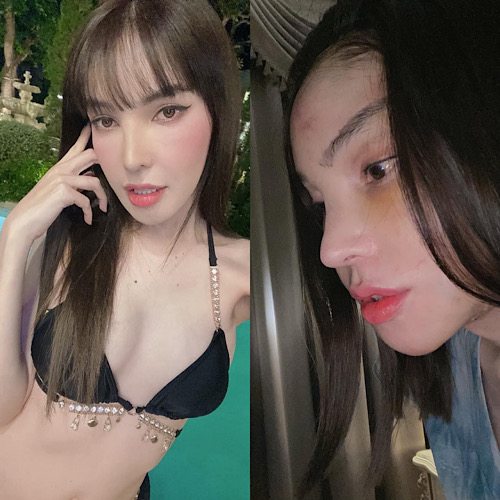 ข่าวบันเทิง - จำแทบไม่ได้ เอมมี่ รัชฎา ศัลยกรรม หน้าเปลี่ยนไปมาก