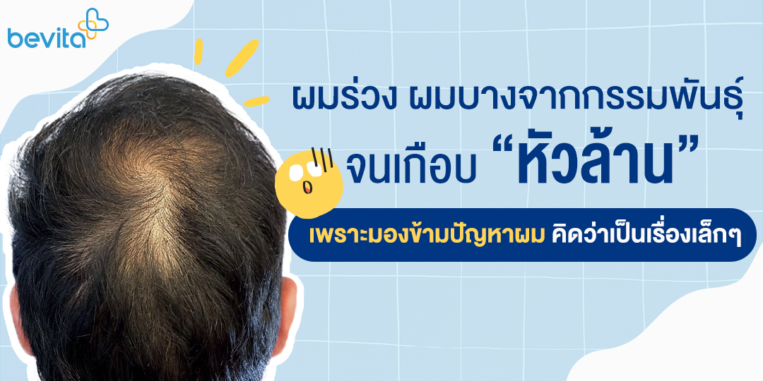 ข่าวสุขภาพ - ถ้าคุณกำลังผมร่วง อย่าคิดว่าเป็นเรื่องเล็ก คุณอาจเสี่ยงผมร่วง ผมบางจากกรรมพันธุ์อยู่