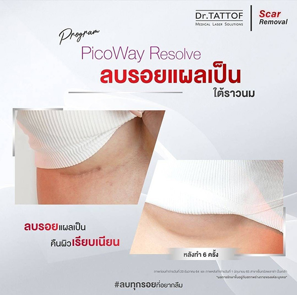 ข่าวความงาม - บอกลาทุกรอยแผลเป็นจากศัลยกรรม ด้วยนวัตกรรมเลเซอร์จาก Dr.TATTOF