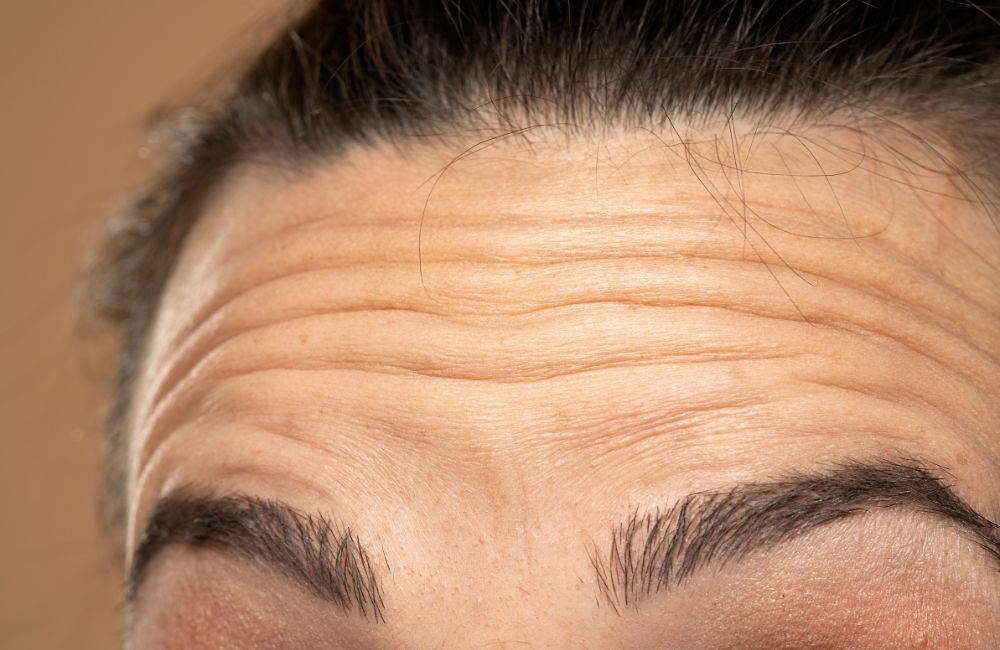 ข่าวความงาม - ดึงหน้าผากชั้นลึกที่ ALINE Clinic ด้วยเทคนิค Triple Lock