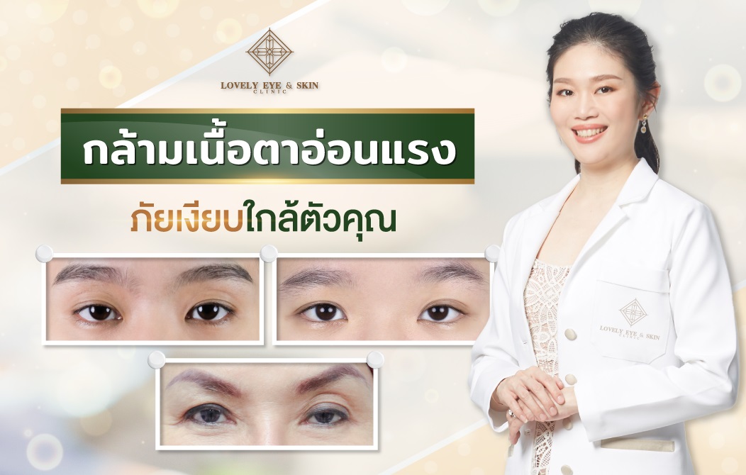 ข่าวสุขภาพ - กล้ามเนื้อตาอ่อนแรง ที่หลายคนคุ้นหู  แต่คาดไม่ถึงว่าเป็นภัยเงียบใกล้ตัวคุณ