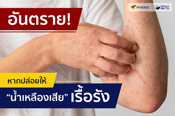 ข่าวสุขภาพ - แก้น้ำเหลืองเสียด้วยพลังยาแคปซูลสมุนไพรจาก M?HERBS ที่มีส่วนประกอบของเห็ดกระถินพิมาน ข้าวเย็นเหนือ ข้าวเย็นใต้
