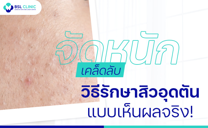 ข่าวความงาม - จัดหนัก ขอบอกเคล็ดลับวิธีรักษาสิวอุดตัน แบบเห็นผลจริง