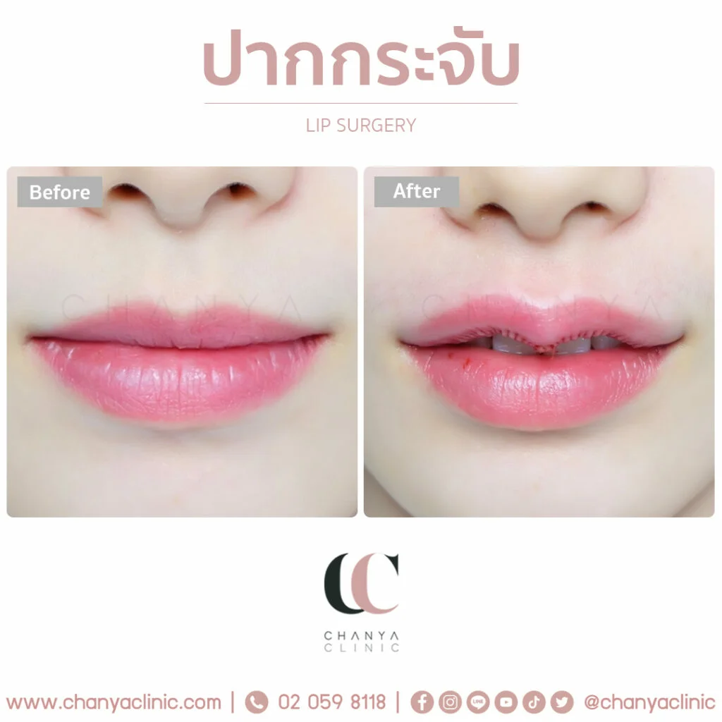 ข่าวความงาม - เทรนการศัลยกรรมปากกระจับ 2022