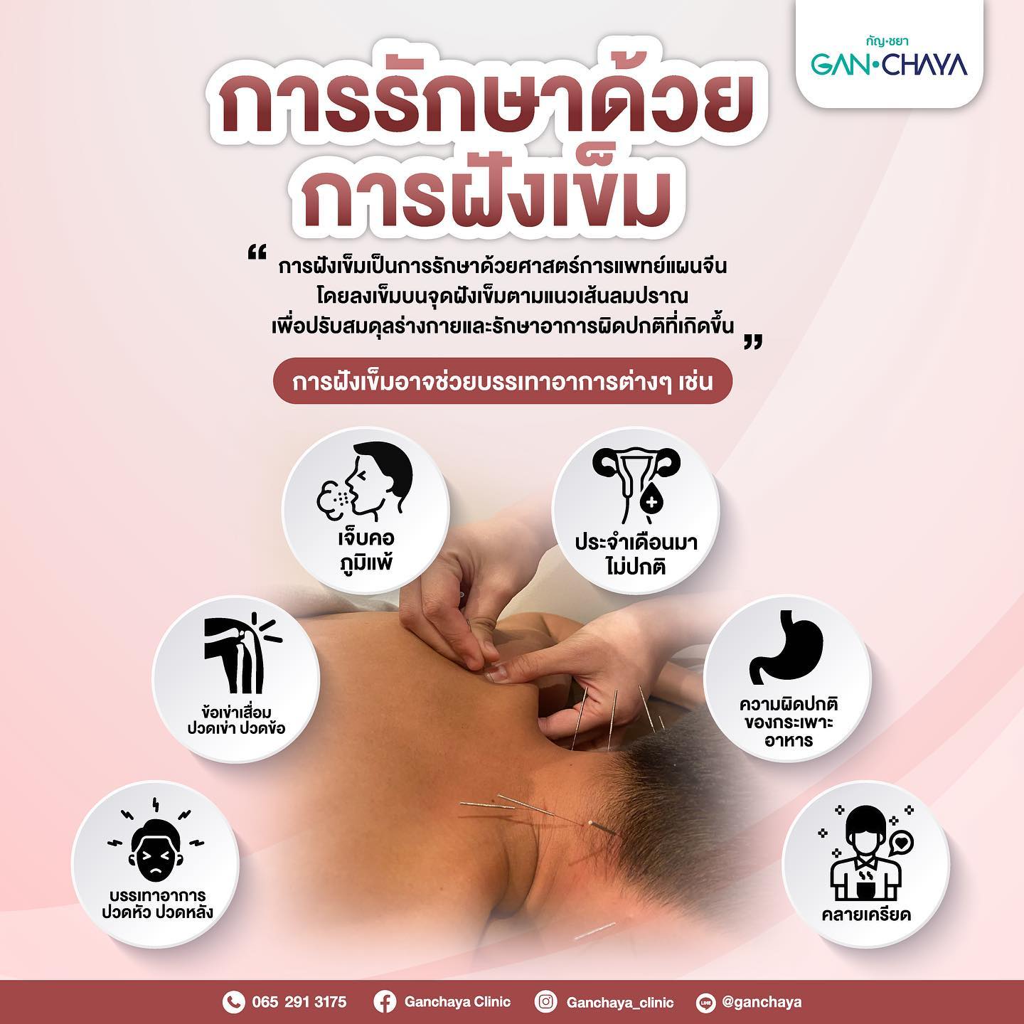 ข่าวประชาสัมพันธ์ - PR News กัญชยา สหคลินิก ในเครือ บริษัท ทีเอชซีจี กรุ๊ป จำกัด เปิดตัว หัตถการจากศาตร์แห่งแพทย์แผนจีนเข้ามาเป็นอีกหนึ่งทางเลือกให้กับผู้ที่มีปัญหาด้านสุขภาพ