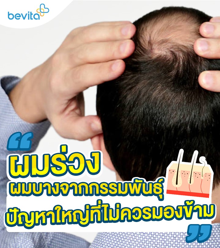 ข่าวสุขภาพ - ผมร่วง ผมบางจากกรรมพันธุ์ ปัญหาใหญ่ที่ไม่ควรมองข้าม